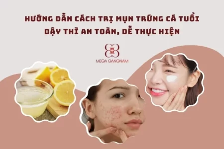 Cách điều trị mụn trứng cá tuổi dậy thì