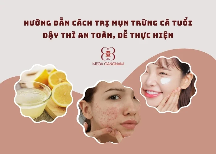 Cách điều trị mụn trứng cá tuổi dậy thì