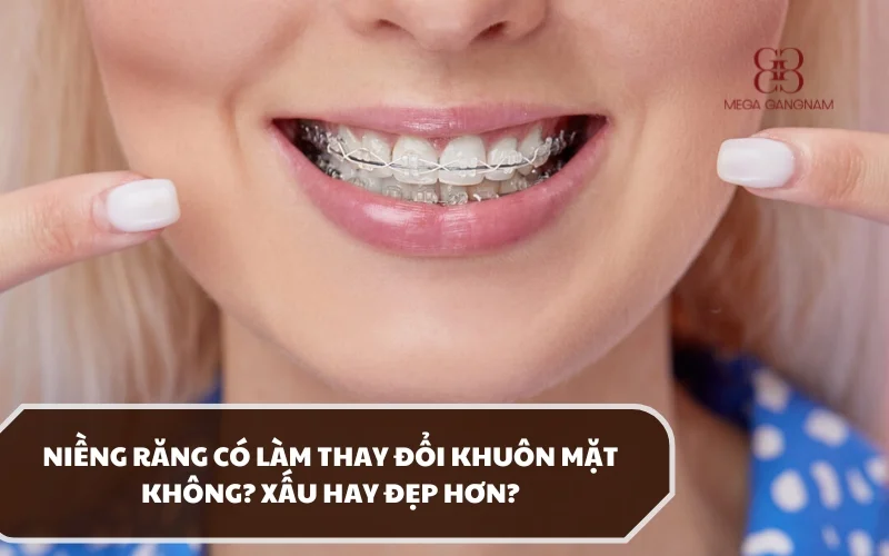 Thực hiện thủ thuật niềng răng có làm thay đổi khuôn mặt không? Nếu có thì như thế nào? 