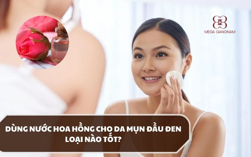 Có nên dùng nước hoa hồng cho da mụn đầu đen hay không? Loại nào phù hợp? 