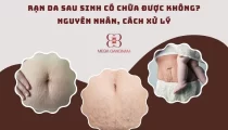 Rạn da sau sinh có chữa được không?