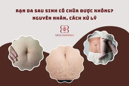 Rạn da sau sinh có chữa được không?