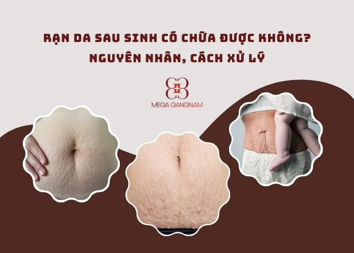 Rạn da sau sinh có chữa được không?