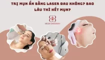 Trị mụn ẩn bằng laser đau không?