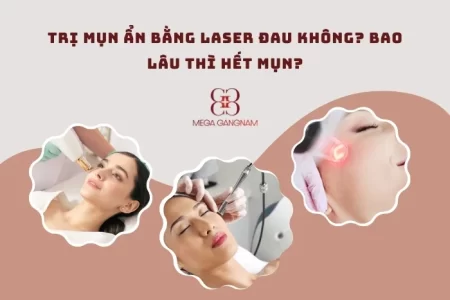 Trị mụn ẩn bằng laser đau không?