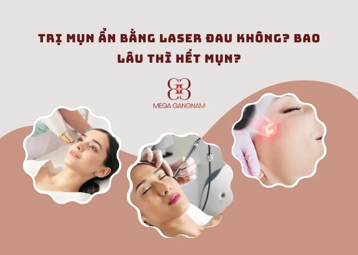 Trị mụn ẩn bằng laser đau không?