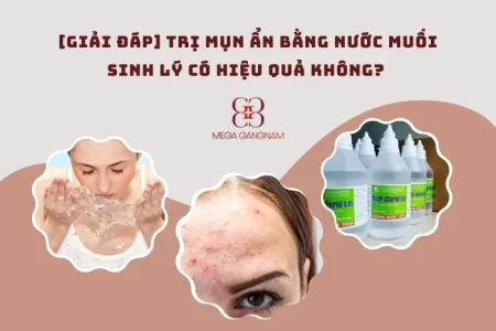 Trị mụn ẩn bằng nước muối sinh lý có hiệu quả không? 