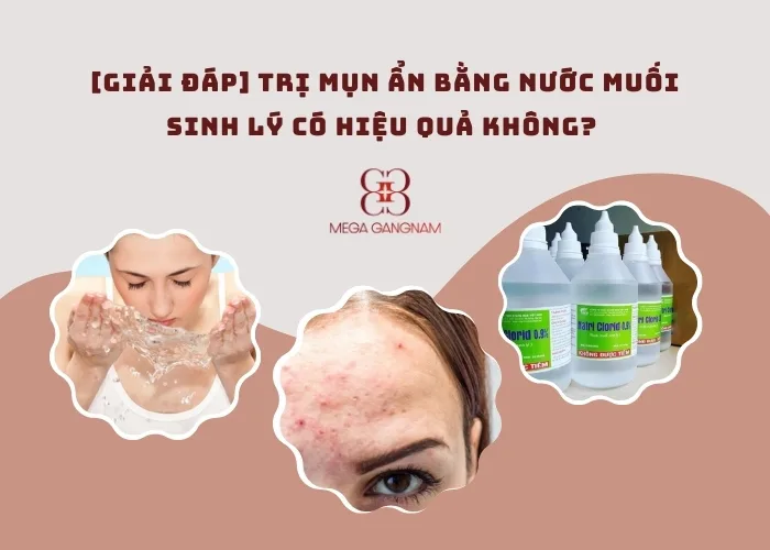 Trị mụn ẩn bằng nước muối sinh lý có hiệu quả không? 