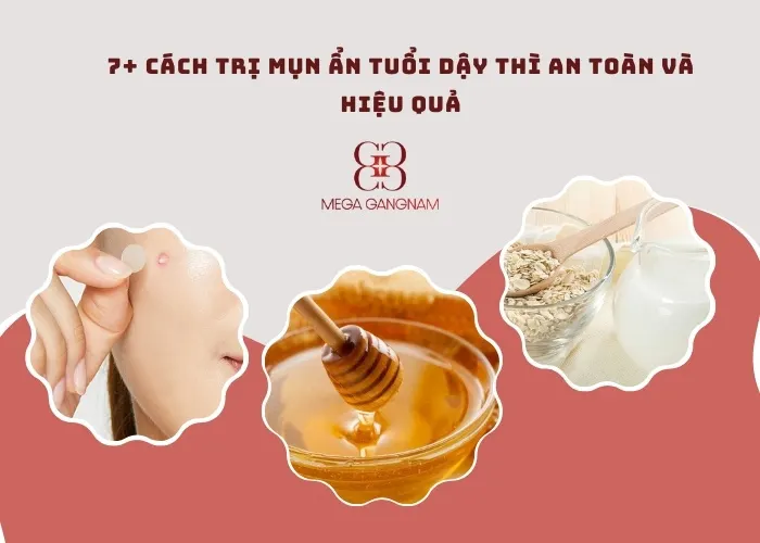 7+ cách trị mụn ẩn tuổi dậy thì an toàn và hiệu quả