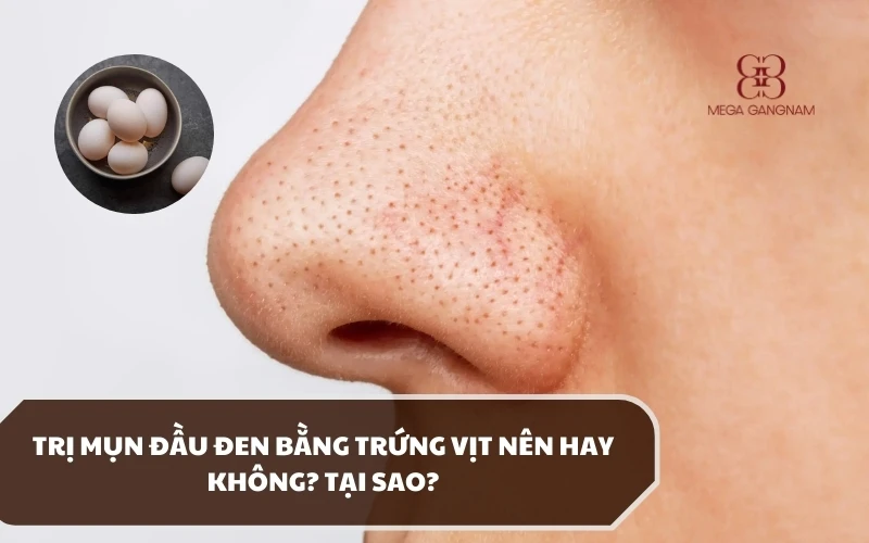 Giải đáp trị mụn đầu đen bằng trứng vịt có hiệu quả và an toàn hay không? 