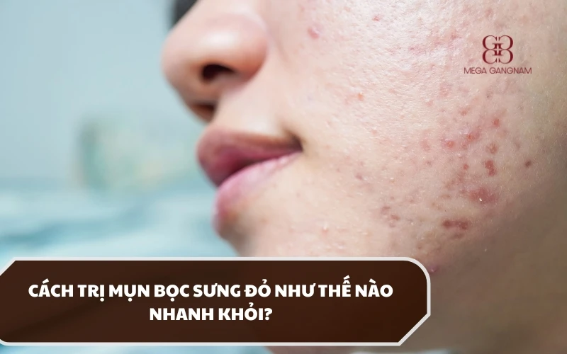 Hướng dẫn cách trị mụn bọc sưng đỏ an toàn theo khuyến nghị của bác sĩ da liễu 