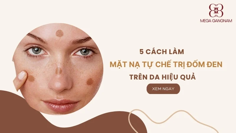 5 cách làm mặt nạ tự chế trị đốm đen trên da hiệu quả