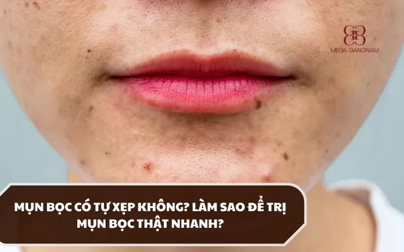 Bác sĩ giải đáp chi tiết mụn bọc có tự xẹp không và đâu là hướng điều trị an toàn? 