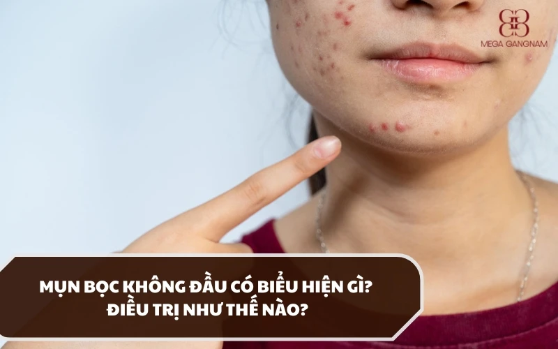 Tổng hợp các dấu hiệu nhận biết mụn bọc không đầu, nguyên nhân và hướng điều trị