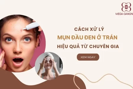 Cách xử lý mụn đầu đen ở trán hiệu quả từ chuyên gia