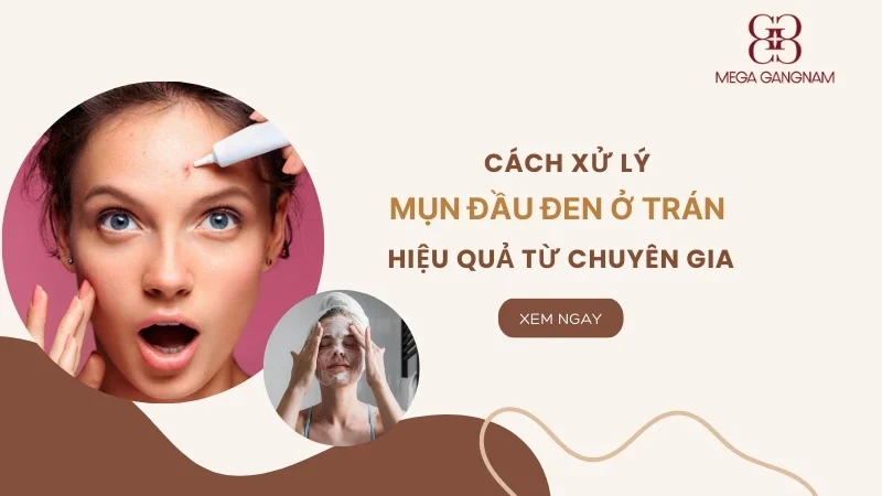 Cách xử lý mụn đầu đen ở trán hiệu quả từ chuyên gia