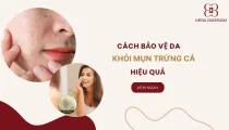 [Hướng dẫn] Cách bảo vệ da khỏi mụn trứng cá