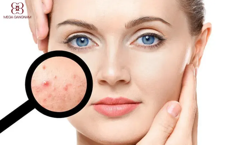 Mụn xuất hiện do vi khuẩn P.acnes tích tụ nang lông 